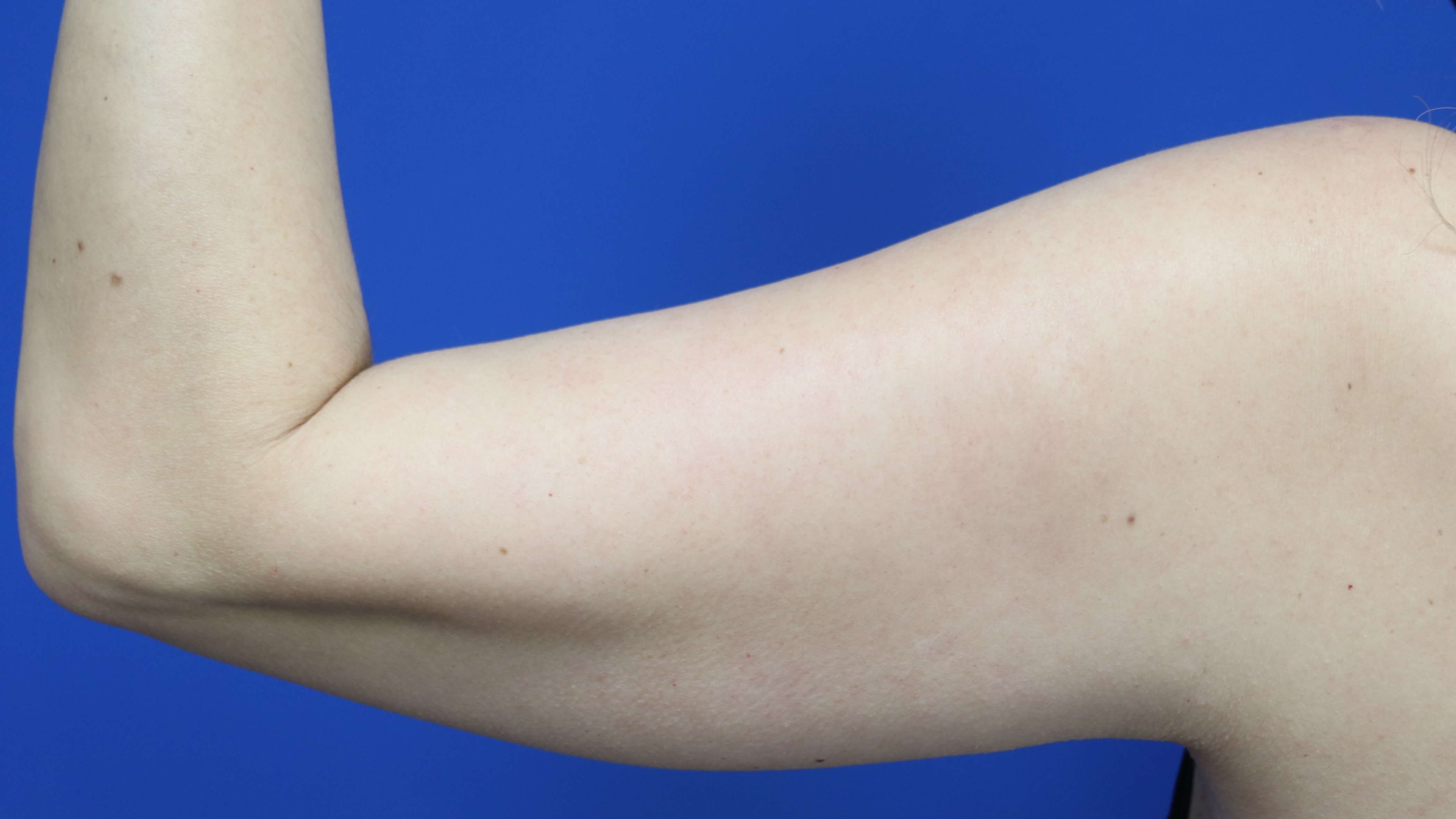 Back view of 50 year-old's arm